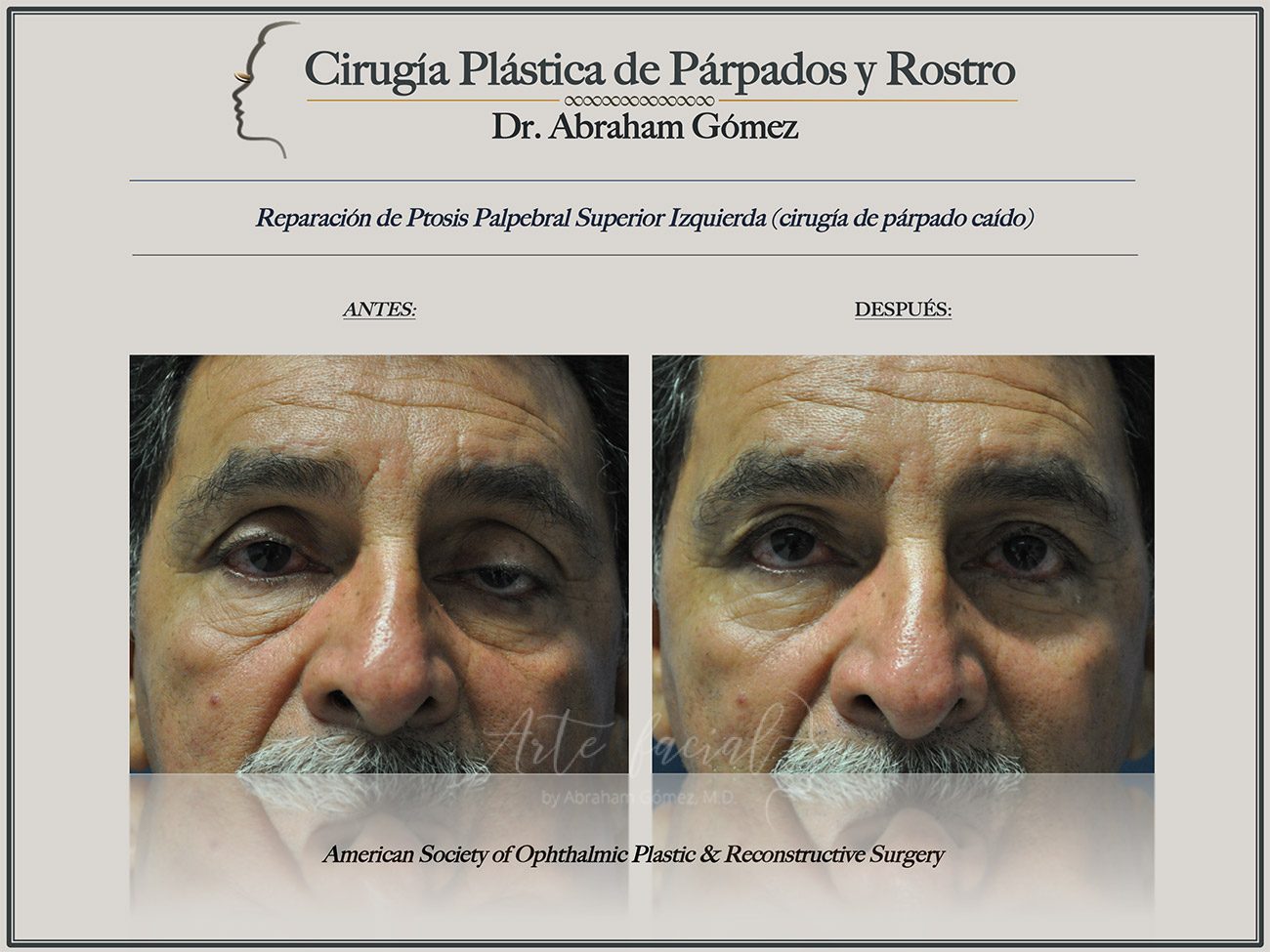 Tratamientos para párpados caídos en Costa Rica - Ptosis