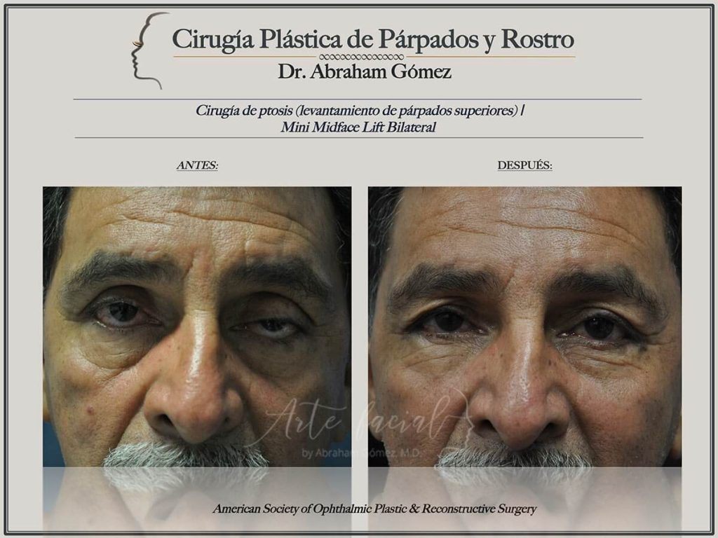 Droopy Eyelid Surgery - Ptosis