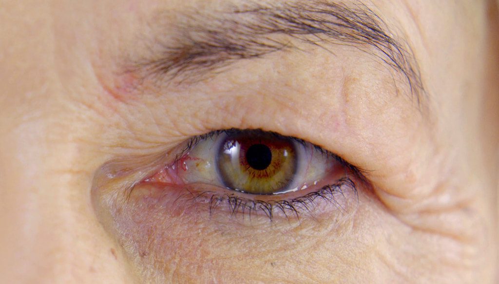 Eyelid Lift Surgery (Upper Blepharoplasty)