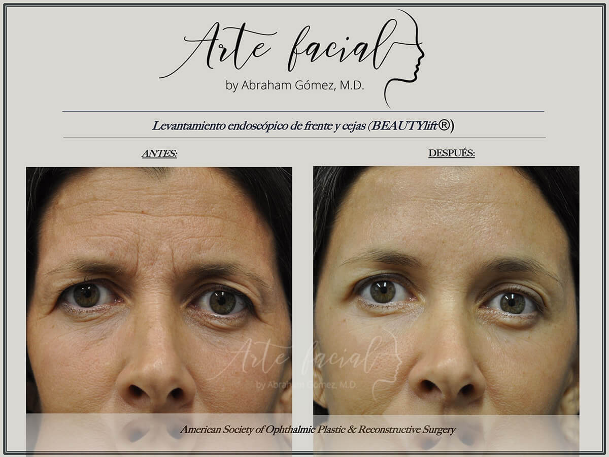 Eye and eyelid plastic surgery in Costa Rica - Arte Facial