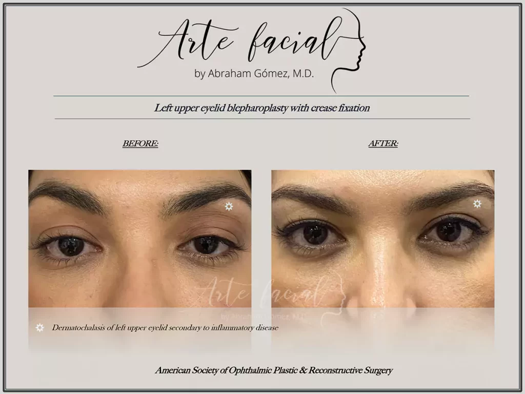 Before and after blepharoplasty
