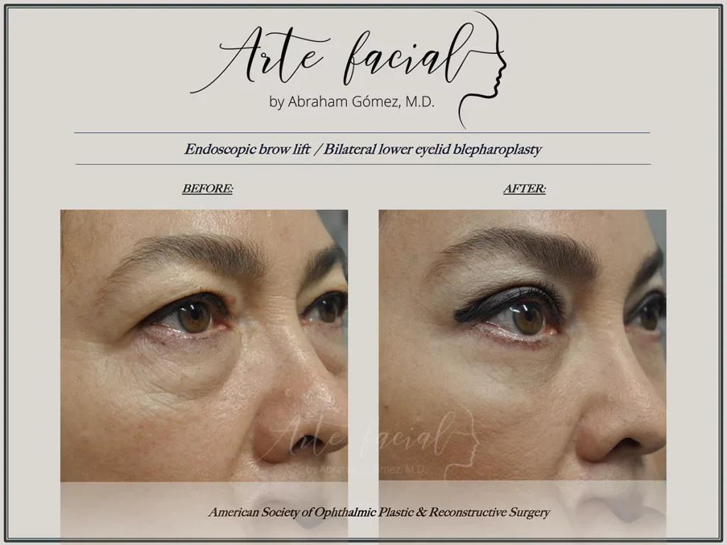 Before and after brow lift and blepharoplasty