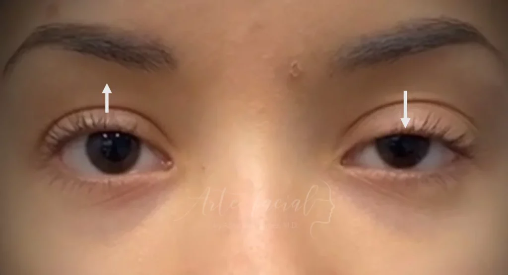 The droopy eyelid is the eyelid with ptosis