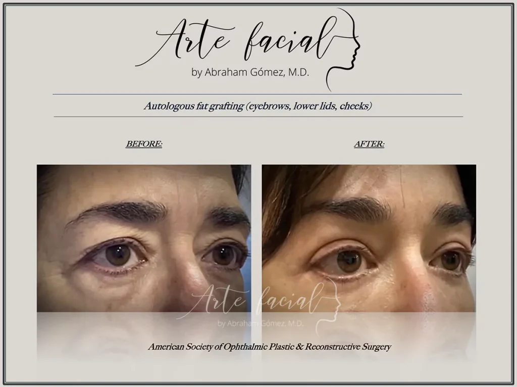 Facial Fat Transfer Before and After in Costa Rica